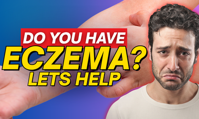 Eczema Flare-Ups? Here's How to Calm the Cycle Naturally