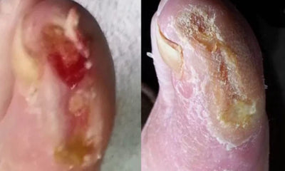 Case Study – Diabetic Foot Ulcer