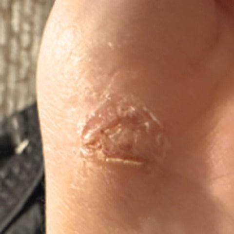 Minor abrasion., Day 3