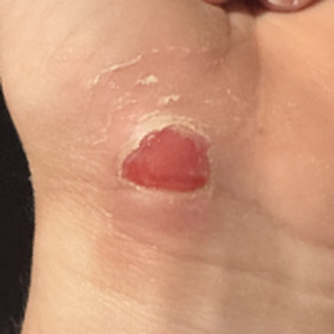 Minor abrasion., before