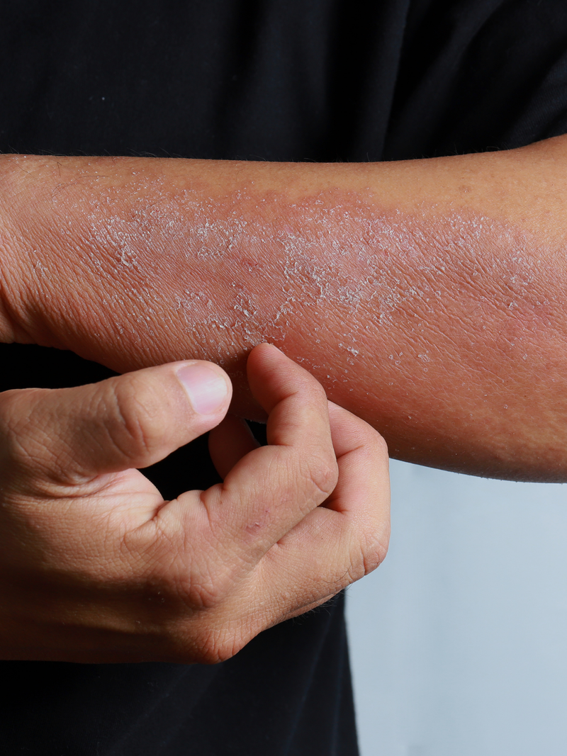 Person scratching dry, irritated skin on the forearm