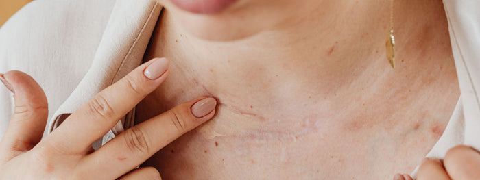 How to Support the Appearance of a Scar After Surgery