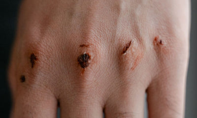 How to Treat a Minor Burn at Home