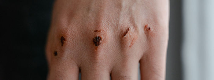 How to Treat a Minor Burn at Home