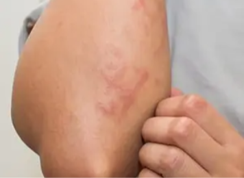 Dry, irritated skin associated with eczema in people with diabetes