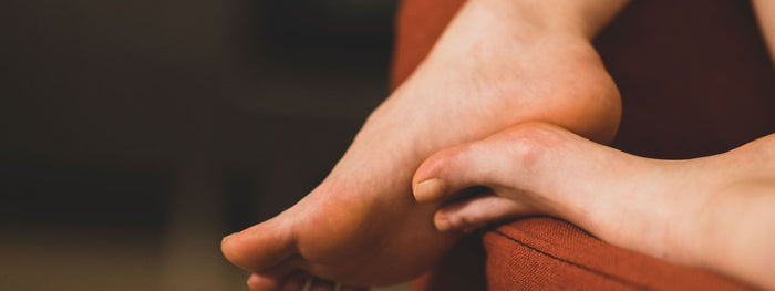 Cracked Heels: Why They Happen and How to Treat Them