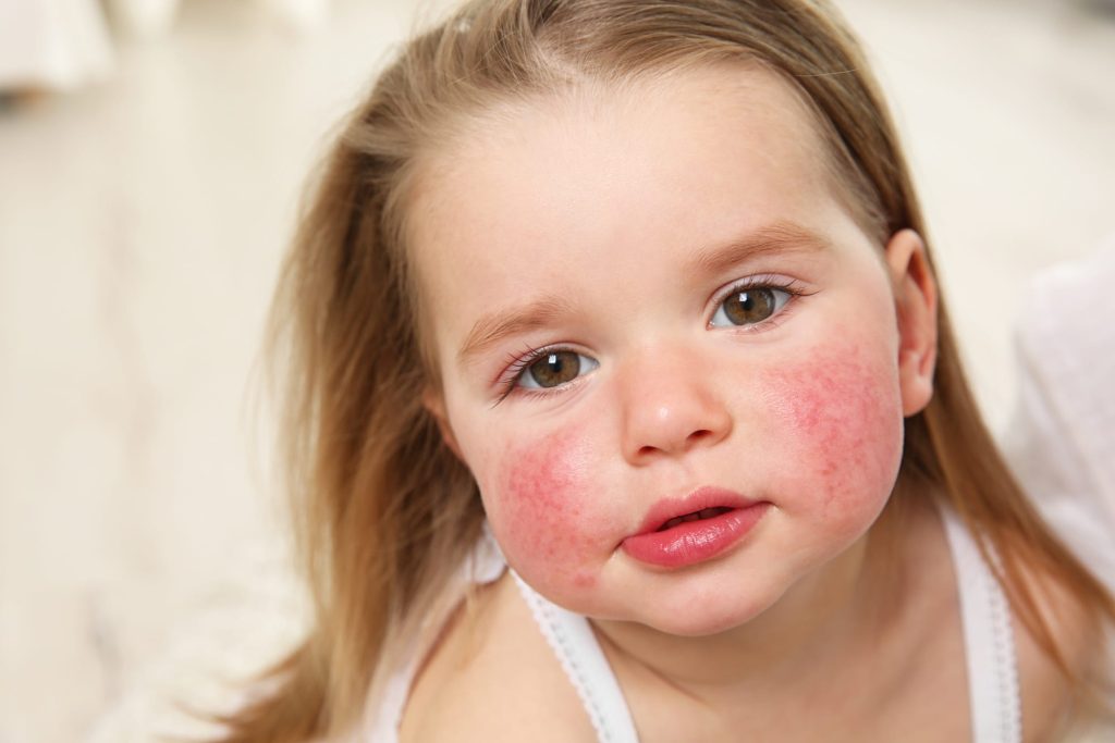Young girl with a red rash on her cheeks