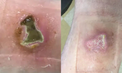 Case Study – Diabetic Laceration