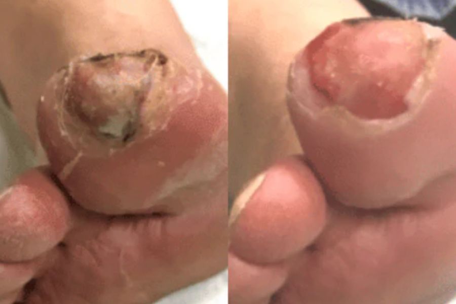 Case Study – Diabetic Toe Ulcer