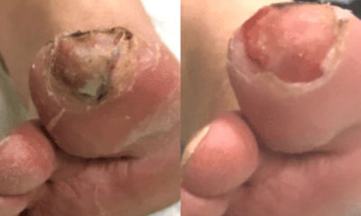 Case Study – Diabetic Toe Ulcer