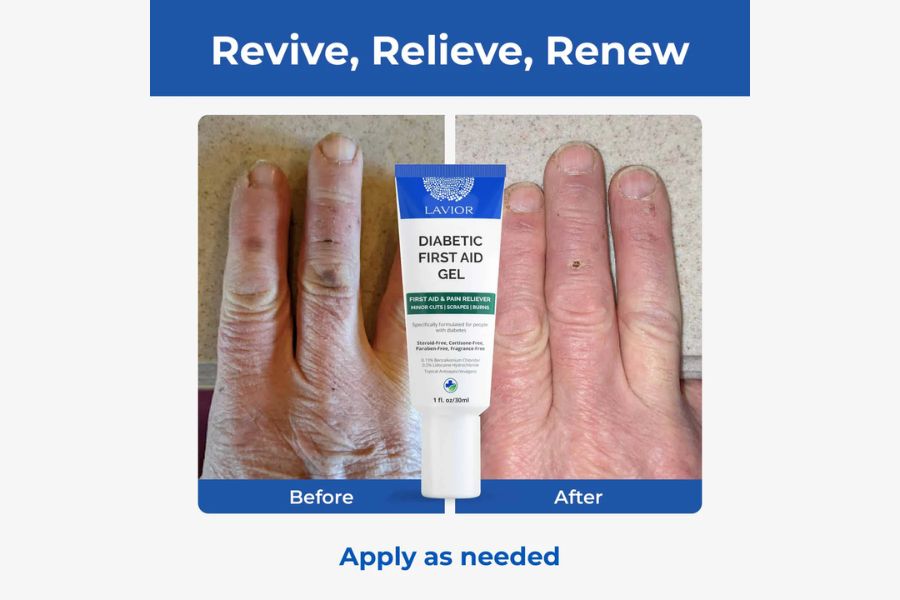 Wound hydrogel gel applied to a minor skin injury