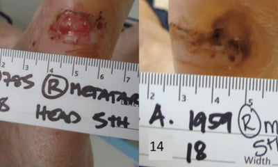 Case Study – Diabetic Ulceration