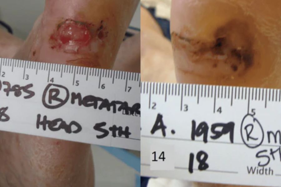 Case Study – Diabetic Ulceration