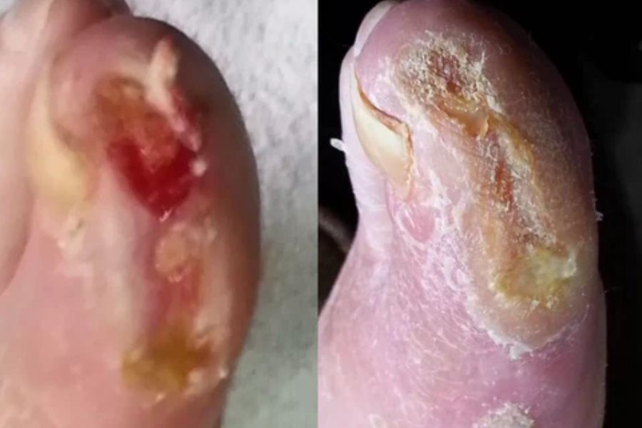 Case Study – Diabetic Foot Ulcer