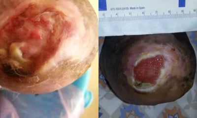 Case Study – Non-Healing Partial Foot Amputation