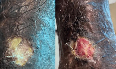 Case Study – Medial Malleolus Ulcer