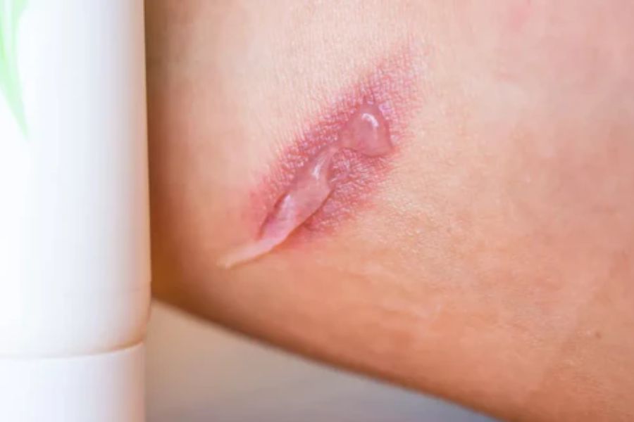 Fighting The Battle Of Diabetic Wounds (And Winning!)