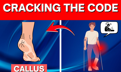 Cracking the Code on Diabetic Calluses: When They Become Dangerous