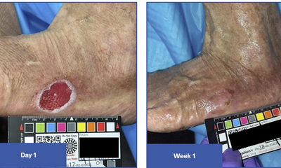 Diabetic Foot Ulcer