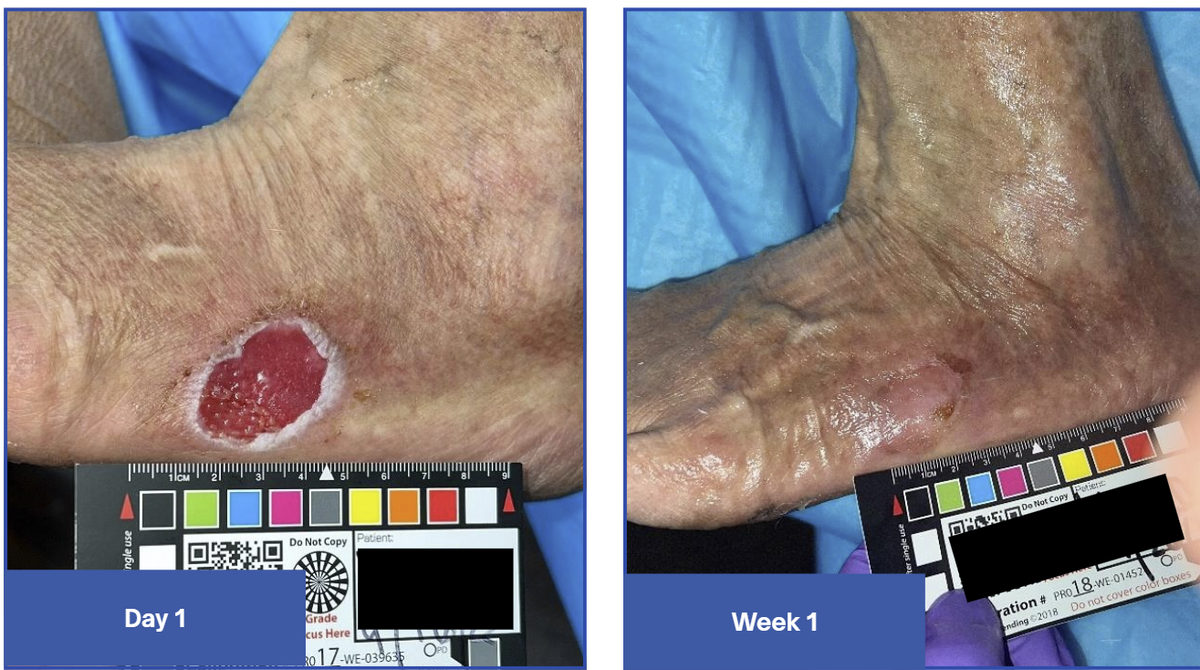 Diabetic Foot Ulcer
