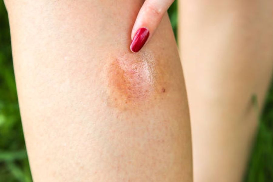 Insulin pump infusion site on the skin