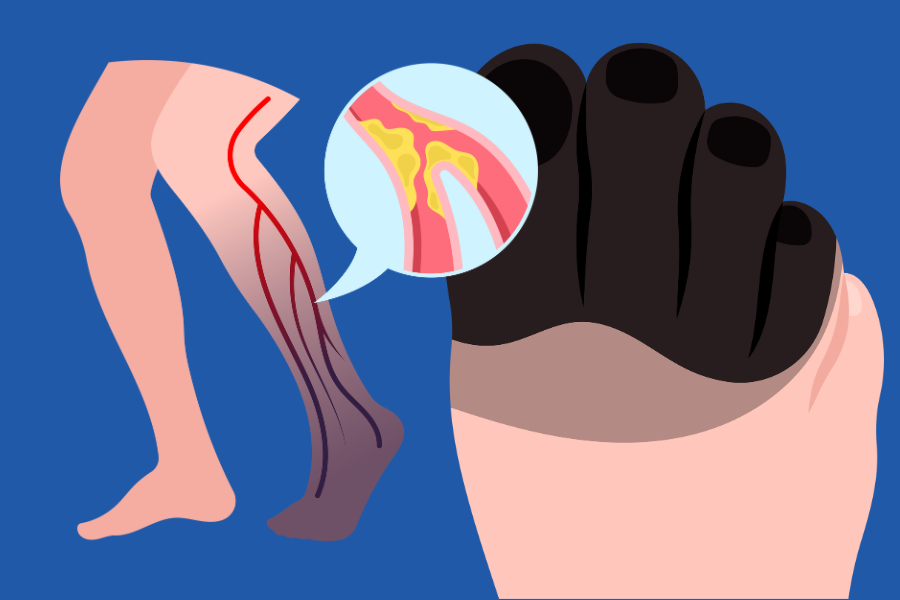 Caring for Diabetic Feet: Top Picks for Health and Wellness in Footwear and Accessories