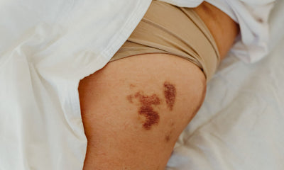 Close-up of a bruise on the leg