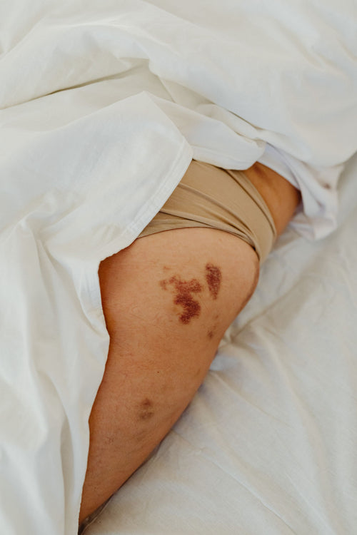 Close-up of a bruise on the leg