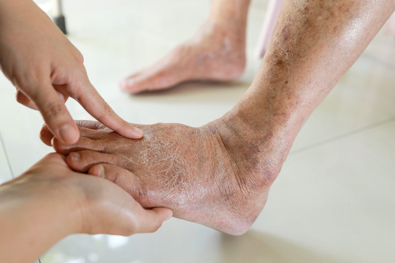 The Importance of Diabetic Skin Care: 8 Tips for Maintaining Healthy Skin