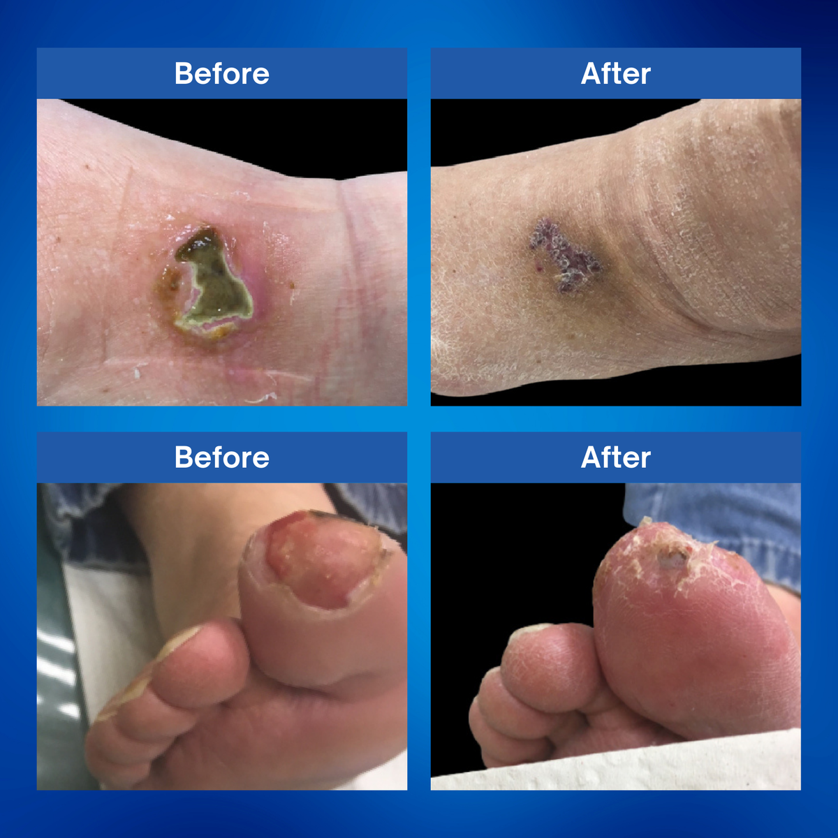 Diabetic Wound Therapy Gel - 1oz