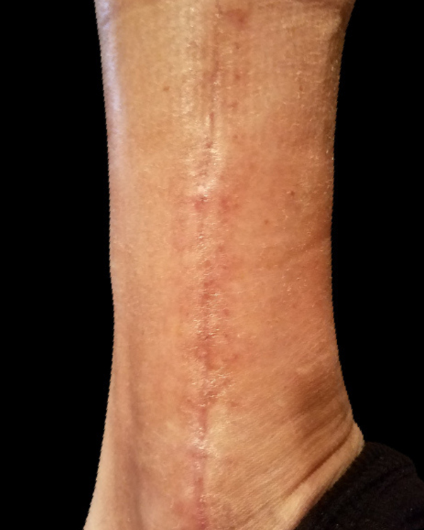 1 Week After