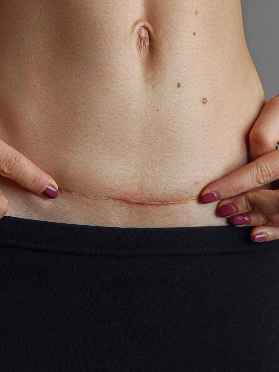 Post-Surgical Skin Barrier